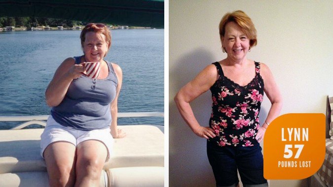 Lynn's Profile by Sanford Weight Loss Journey. Side-by-side before and after photos.